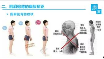 纠正驼背视频,跟随专业视频，轻松告别不良体态